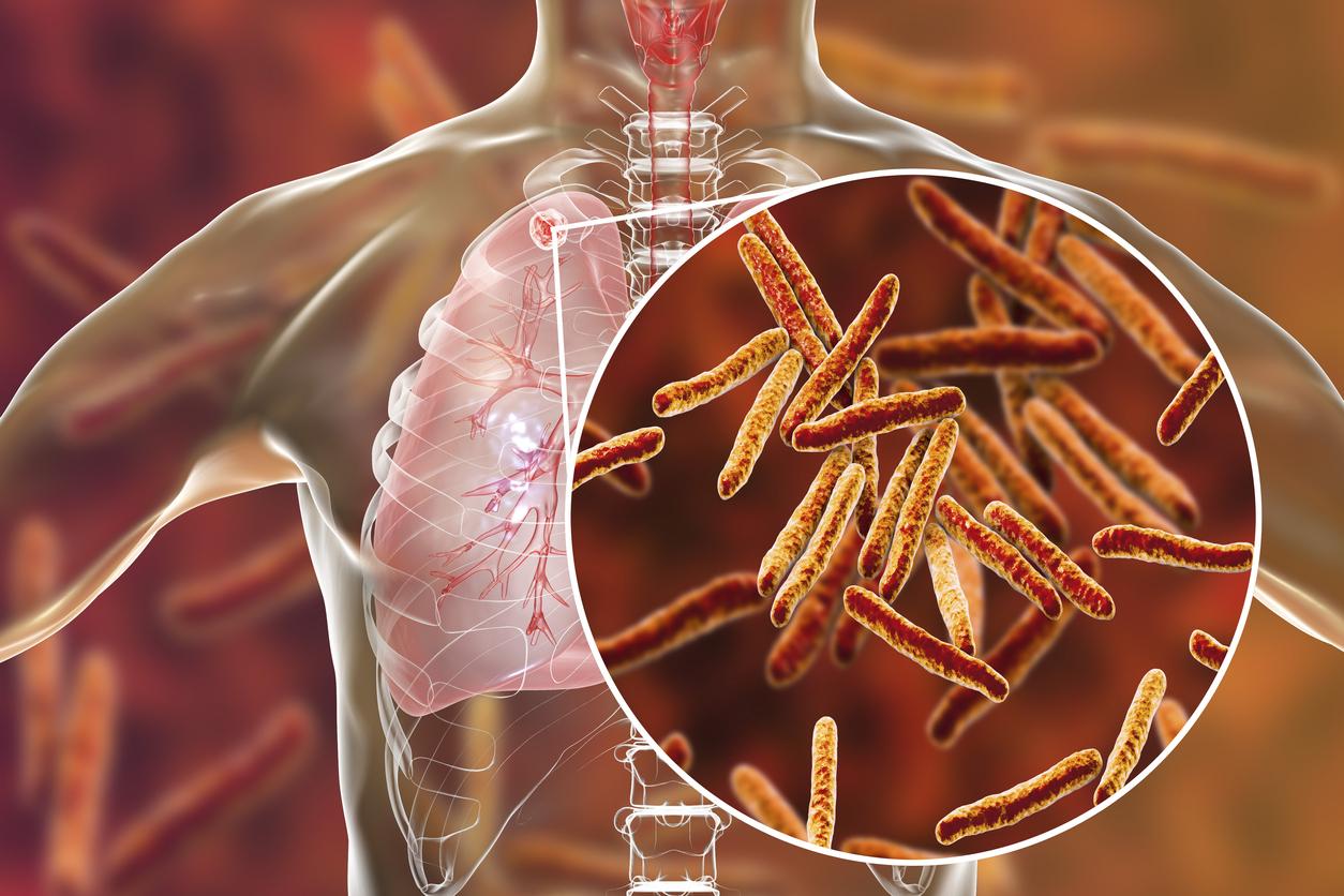 Fibrose pulmonaire : la charge bactérienne des voies aériennes basses prédit la progression mais indépendamment de l’extension TDM