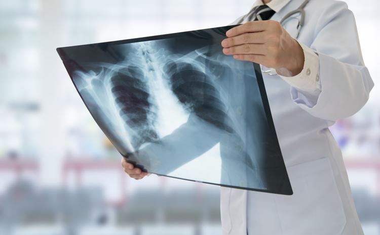 Fibrose pulmonaire : un rôle probable de l'auto-immunité locale.