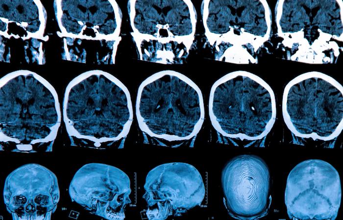 Parkinson : un score de risque de déclin cognitif