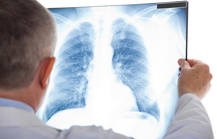 Cancer du poumon : l'immunothérapie serait plus efficace lorsqu'il existe une BPCO