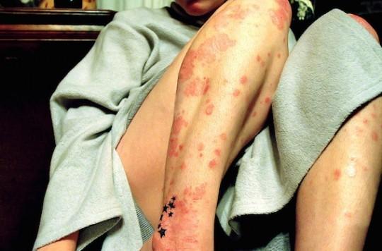 Psoriasis en plaque : un anti-IL17 améliore les lésions palmoplantaires en 2 semaines