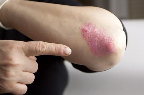 Psoriasis : nouvelles opportunités et nouvelles stratégies