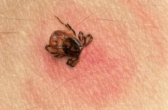 Lyme : un plan national de lutte contre la maladie