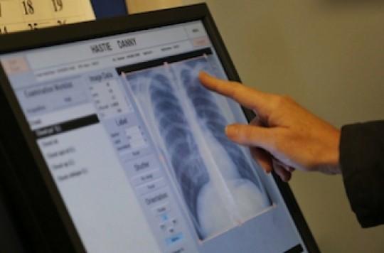 Risque tuberculeux : un scanner thoracique au moindre doute