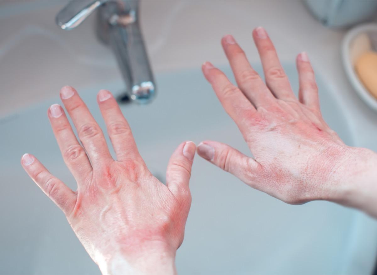 Gestes barrières et gel hydroalcoolique : flambée de dermatites des mains