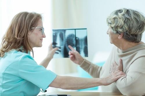 Ostéoporose: succès d'une nouvelle thérapie ciblée