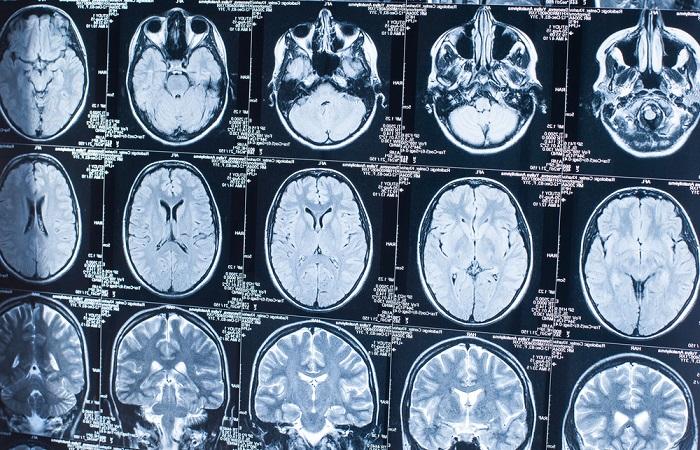 Avancée majeure dans la connaissance du cerveau : création d’une banque d’images de référence par IRM