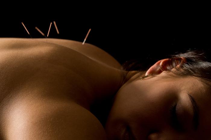 Acupuncture : un pouvoir contre la douleur et les allergies