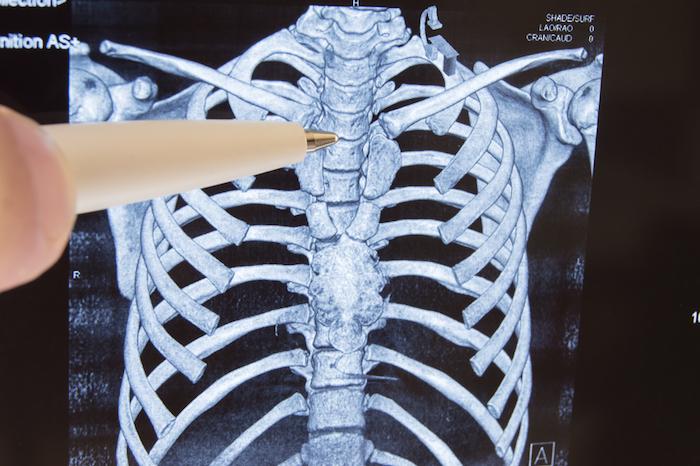 Métastases osseuses : une nouvelle cible et une nouvelle thérapie ciblée