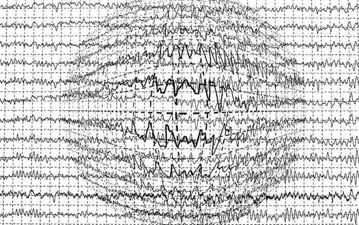 Epilepsie : les traitements modernes pas plus efficaces que les anciens