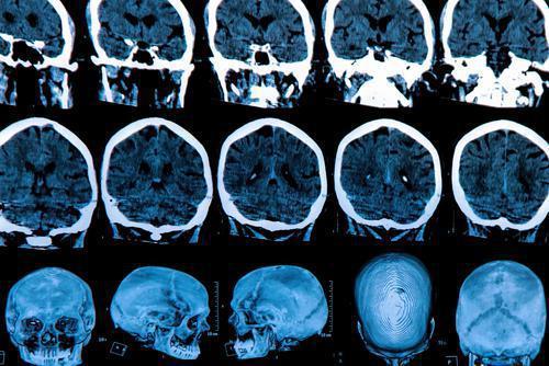 Parkinson : un dysfonctionnement cognitif annonciateur de la maladie