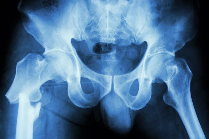 FRAX : le dépistage réduit de près d'un tier des fractures de hanche