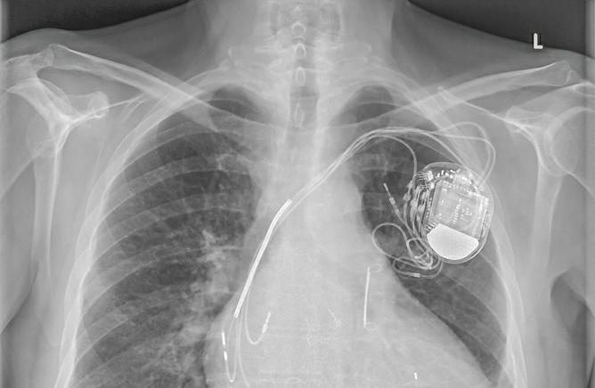 Pacemaker : Il est possible de passer une IRM sans risque