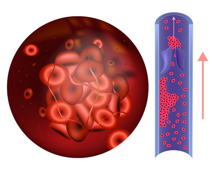  Arthroplastie : la prévention de la thrombose veineuse change de dimension