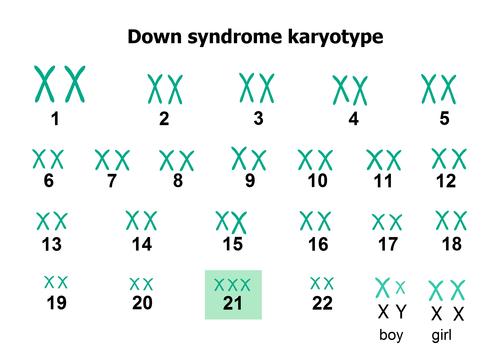 Trisomie 21 : une surproduction d'ARN messagers perturbe les cellules