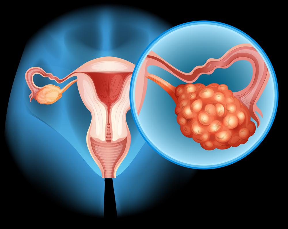 Cancer de l'ovaire : quid de la pertinence du dépistage chez les femmes asymptomatiques