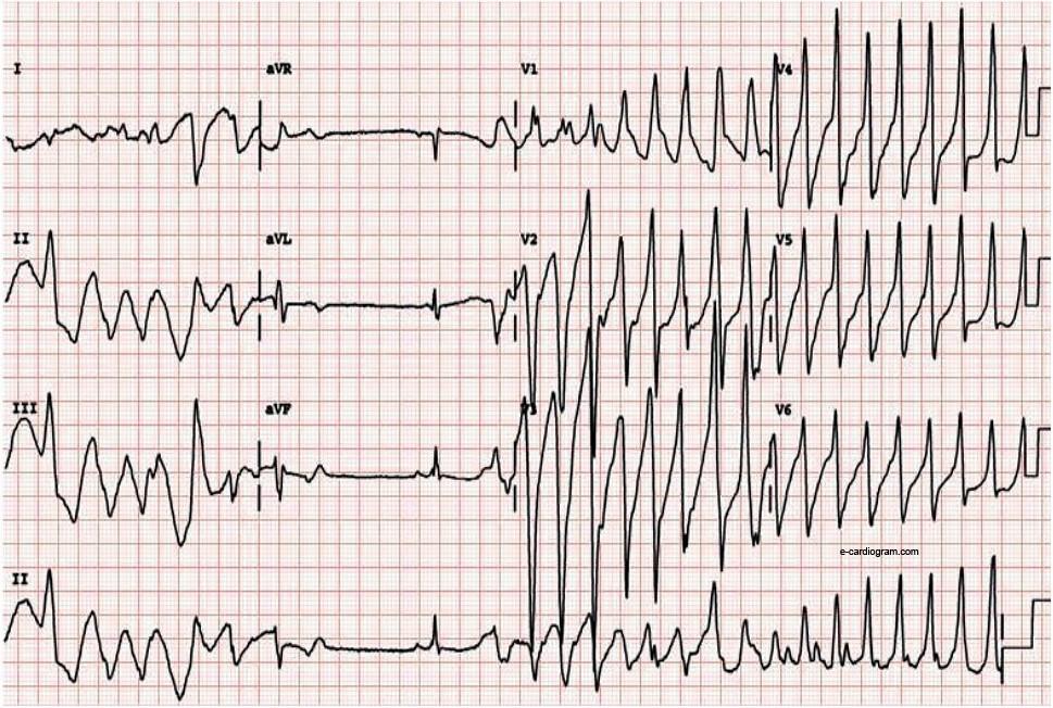 Anomalies du QT : un test génétique prédictif pour les médicaments à risque