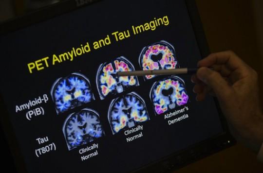 Alzheimer : la mémorisation est altérée à causes des perturbations du sommeil