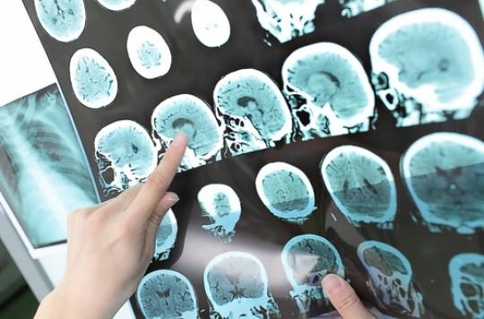 TDAH : une large étude d'imagerie trouve des anomalies cérébrales 
