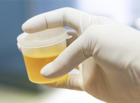Cancer de la prostate : un test de dépistage urinaire en développement