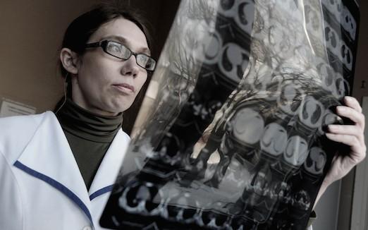 Double espoir dans la fibrose pulmonaire