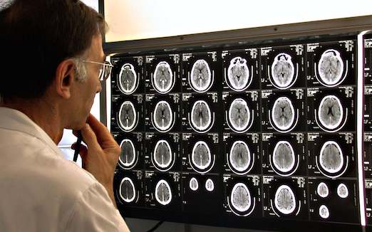 Cerveau : comment l’ICM fait avancer la recherche